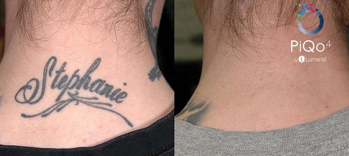 Are Homemade Tattoos Easier To Remove  North Houston Laser Tattoo Removal