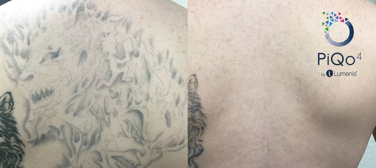 Tattoo Removal Update Cost PAIN Full DetailsLaser Tattoo Removal  Before  After Sessions 14  YouTube