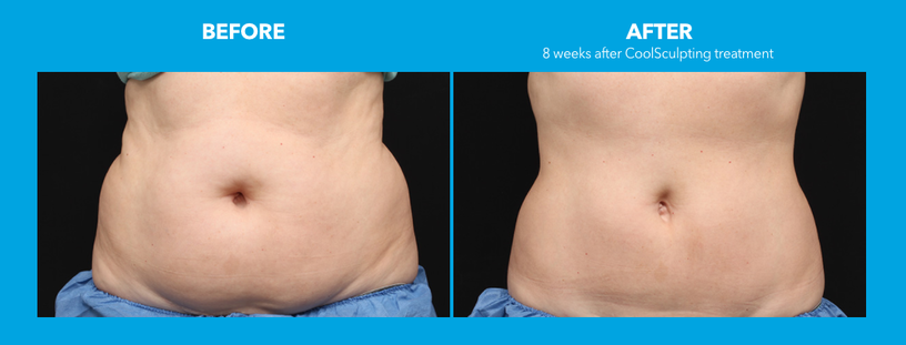 9 Areas of Your Body You Can Reshape with CoolSculpting® - Skin